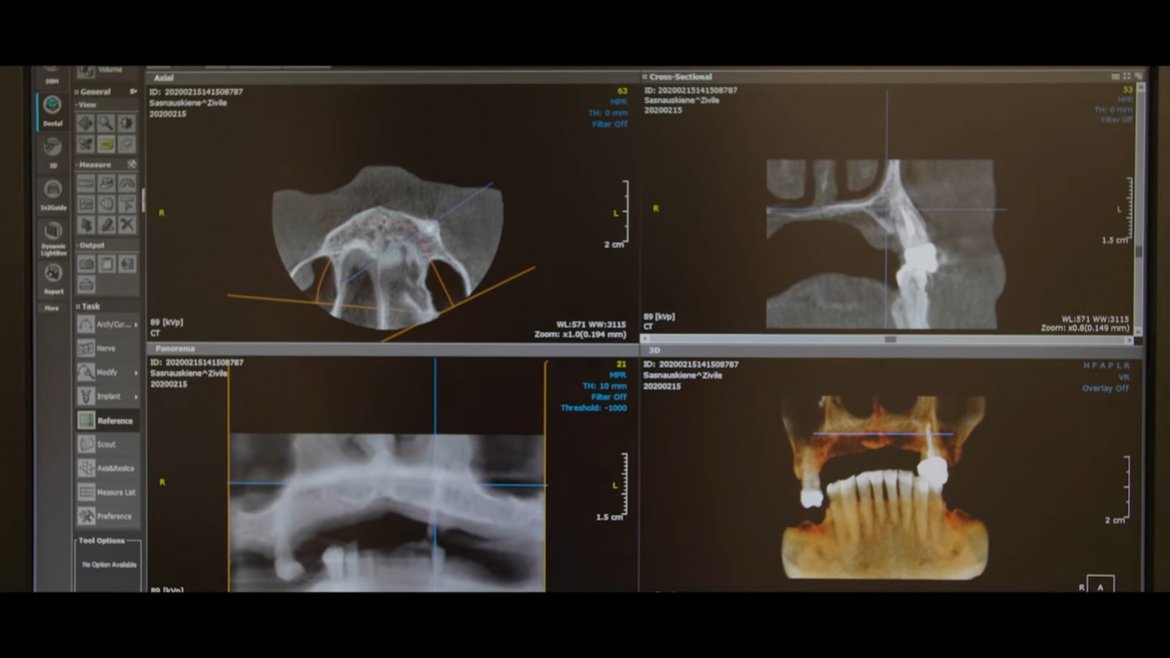 Teeth in a day! All on 6 London